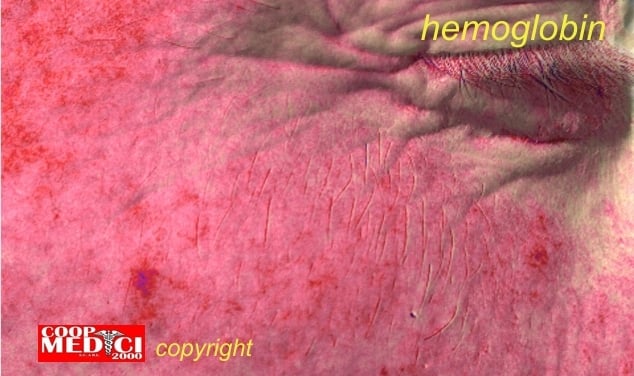 Immagine di una pelle arrossata per aumento della emoglobina cutanea, occhio chiuso con ciglia e scritta gialla emoglobina