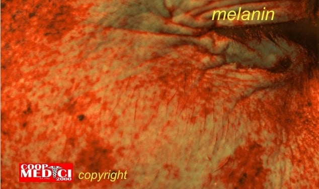 Immagine della quantità di melanina nella pelle rappresentata in colore bruno intorno all'occhio e scritta copyright