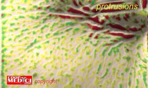 Immagine comuterizzata dei cheloidi e protrusioni della pelle ottenuta con spettroscopia
