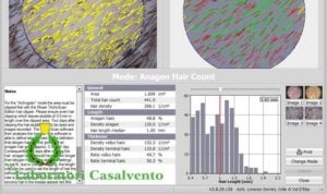 Schermata dei risultati del TrichoScan HD in alto due cerchi con il conteggio dei capelli in giallo, rosso e verde; in basso la statistica con scritta Laboratori Casalvento