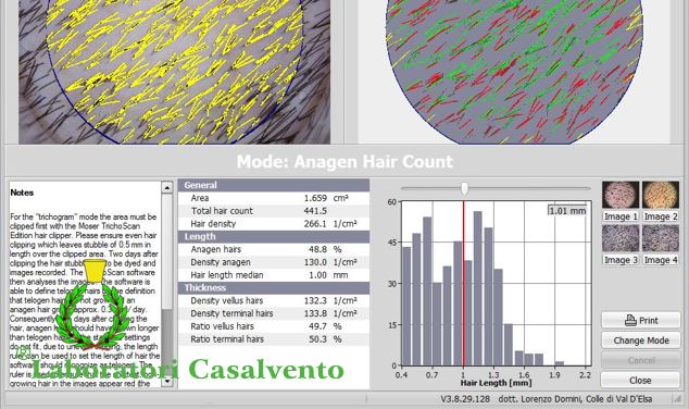 TrichoScan HD results screen above two circles with hair counts in yellow, red and green; at the bottom the statistic with the words Laboratori Casalvento